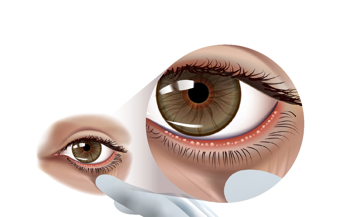 Blepharitis and Meibomian Gland Dysfunction (Sticky and Crusty Eyelids) My Doctor Online